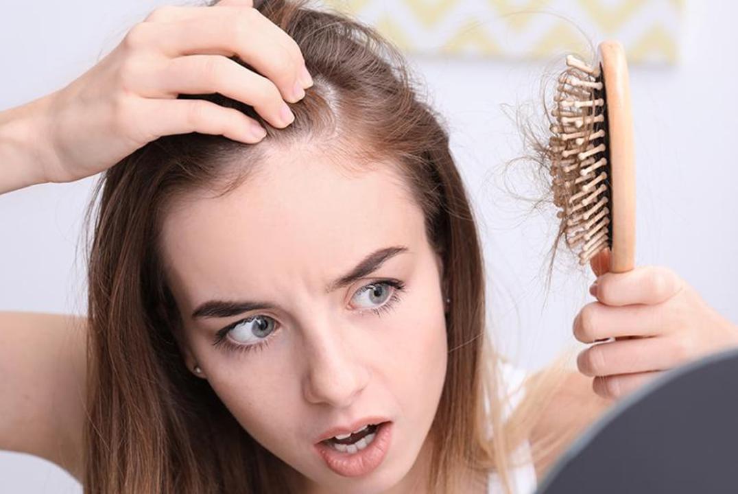 درمان ریزش مو به دلیل pcos